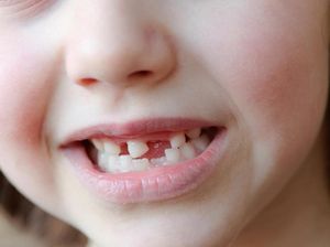 Anakku Kehilangan 3 Gigi Saat Pulang dari Daycare