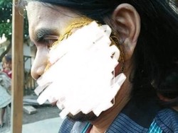 Tolong! Tumor Ganas Ini Tutupi Muka Warga NTB