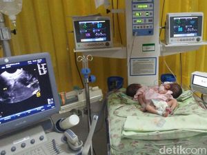 Kasus Bayi Kembar Siam di Jawa Timur Tertinggi Nasional Kasus Bayi Kembar Siam di Jawa Timur Tertinggi Nasional