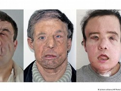 Akibat Penyakitnya, Pria Prancis Ini Punya Tiga Wajah Berbeda