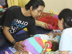Cairan 3 Liter Dikeluarkan dari Perut Bayi yang Membengkak di Surabaya