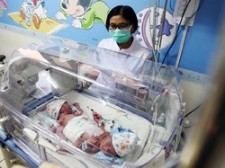 Kepasrahan Orang Tua Bayi Kembar Siam Kaki Tiga Asal Subang