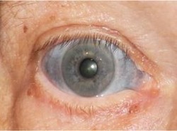 Bagian Putih Mata Pria Ini Berubah Biru Akibat Efek Samping Obat