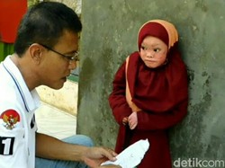 Kasihan Ayu, Bocah Asal Ciamis Ini Kulit Tubuhnya Mengelupas