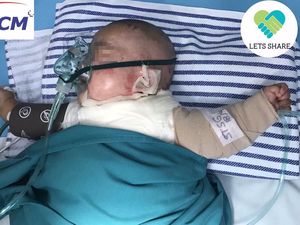 Bantu Dilan Yuk! Bayi 4 Bulan Ini Luka Bakar 45 Persen Tersiram Santan Panas