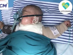 Bantu Dilan Yuk! Bayi 4 Bulan Ini Luka Bakar 45 Persen Tersiram Santan Panas