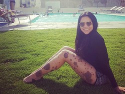 Kisah Inspiratif Wanita Dibully karena Punya Tahi Lalat di Seluruh Tubuh