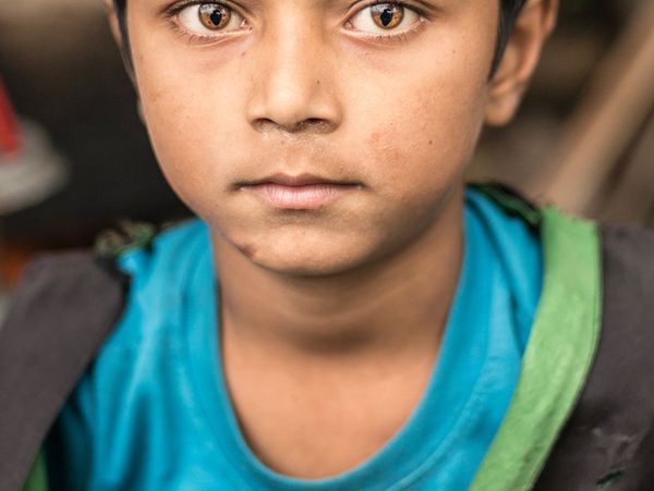 Potret Para Pemilik Mata Kucing Karena Sindrom Langka