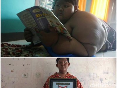 Foto: Before-After Ariya Bocah Terberat Sedunia yang Susut 80 Kg