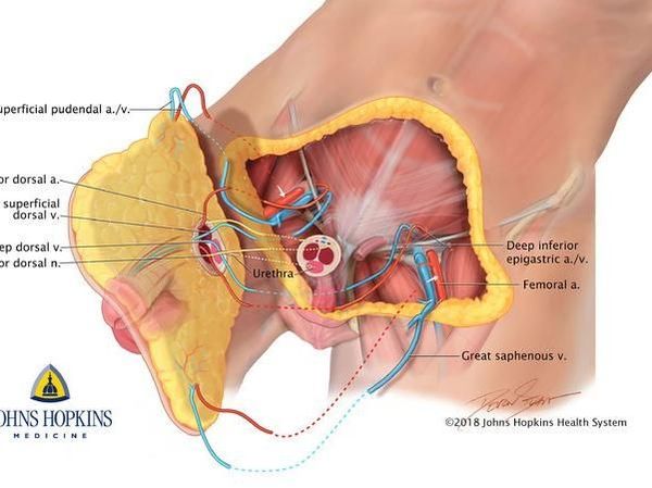 Foto: Begini Cara Dokter Lakukan Transplantasi Penis Utuh Pertama di Dunia