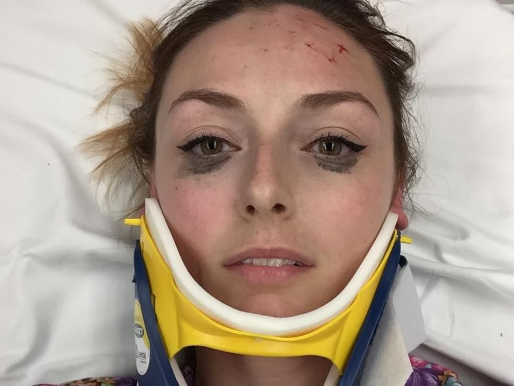 Wajah Memar Habis Kecelakaan Mobil, Wanita Ini Malah Pamer Eyeliner Wajah Memar Habis Kecelakaan Mobil, Wanita Ini Malah Pamer Eyeliner