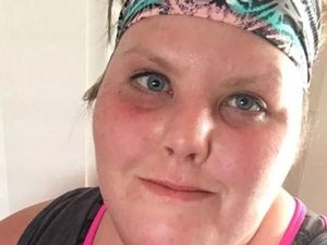 Kelainan Genetik, Wanita Ini Terus Merasa Lapar Meski Sudah Banyak Makan