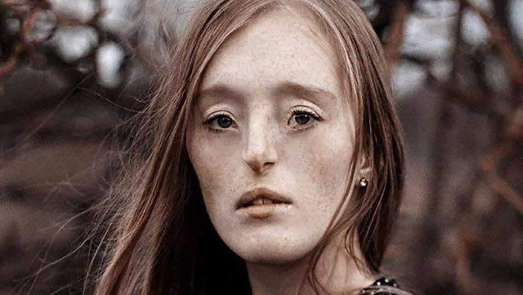 Tersentuh Foto-foto Indah Wanita yang Terlahir dengan Bibir Sumbing Tersentuh Foto-foto Indah Wanita yang Terlahir dengan Bibir Sumbing