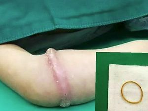 Pakai Karet Gelang di Lengan Selama 6 Bulan, Bocah Ini Dioperasi