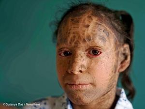 Cerita Vedika, Remaja 13 Tahun yang Sering Diledek Gadis Ular