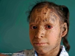 Cerita Vedika, Remaja 13 Tahun yang Sering Diledek Gadis Ular