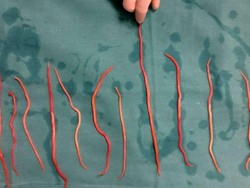 Hal Medis Tentang Kematian Pilu Anak Sukabumi Digerogoti Cacing