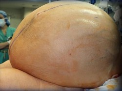 Butuh 12 Dokter untuk Angkat Tumor Raksasa 60 Kilogram dari Wanita Ini