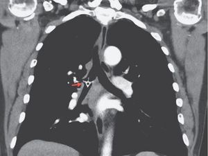 Lima Hari Tulang Ayam Tersangkut di Paru-paru, Kok Bisa?