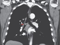 Lima Hari Tulang Ayam Tersangkut di Paru-paru, Kok Bisa?