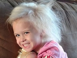 Kisah Bocah yang Rambutnya Mirip Einstein karena Kondisi Langka