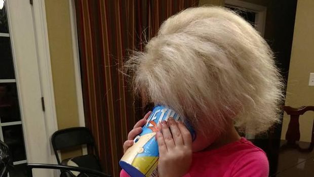 Kisah Bocah yang Rambutnya Mirip Einstein karena Kondisi Langka