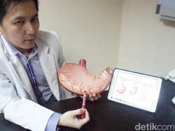 Gemuk dan Mau Operasi Bariatrik Lambung? Tak Sembarangan, Ini Syaratnya