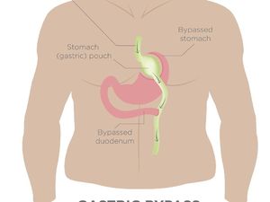 Tak Semua Kegemukan Butuh Operasi, Ini Anjuran Dokter Bedah