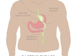 Apa Itu Operasi Bariatrik? Ini Daftar RS di Jatim yang Melayaninya