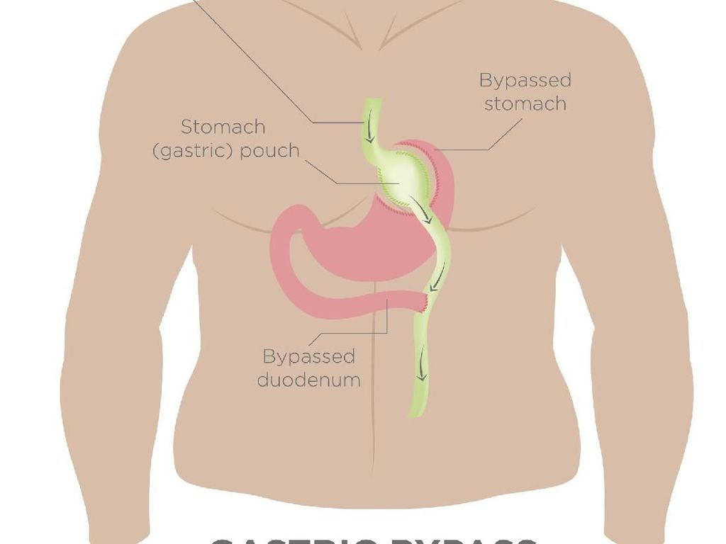 Tak Semua Kegemukan Butuh Operasi, Ini Anjuran Dokter Bedah Tak Semua Kegemukan Butuh Operasi, Ini Anjuran Dokter Bedah