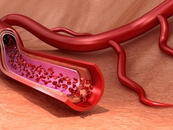 6 Penyebab Penyumbatan Darah pada Jantung Seperti Dialami Arief Rivan