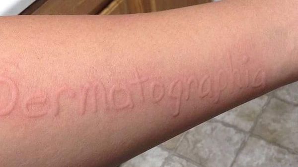 Dermatographia, Kondisi yang Bisa Bikin Tulisan Timbul di Permukaan Kulit
