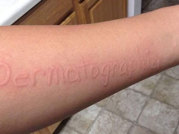 Dermatographia, Kondisi yang Bisa Bikin Tulisan Timbul di Permukaan Kulit
