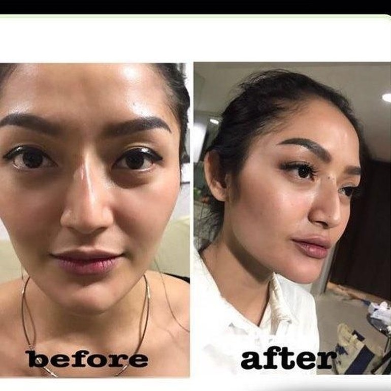 Tanam Benang Di Hidung Butuh Berapa Benang - Berbagi Tanam Tanam Benang Di Hidung Butuh Berapa Benang - Berbagi Tanam