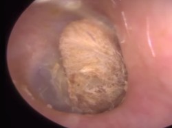 Waduh! Ada Cotton Bud Dua Tahun Tersangkut di Telinga