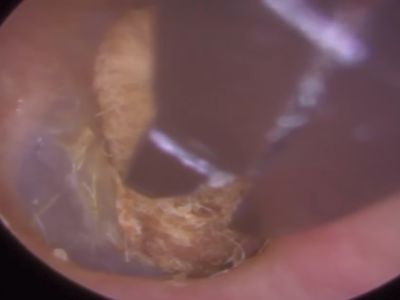 Foto: Penampakan Cotton Bud yang Dua Tahun Tersangkut di Telinga