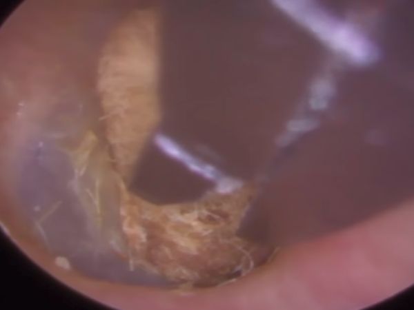 Foto: Penampakan Cotton Bud yang Dua Tahun Tersangkut di Telinga
