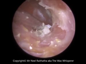 Hii! Wanita Ini Tuli karena Kotoran Telinganya Menyumbat Pendengaran