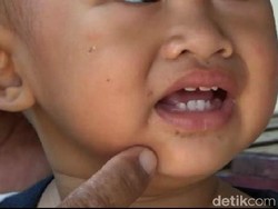 Dokter Bagikan Tips Perawatan di Rumah Bagi Anak yang Kena Flu Singapura