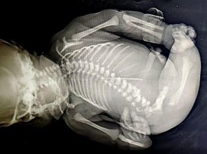 Bayi di India Lahir dengan Sindrom Putri Duyung Langka Bayi di India Lahir dengan Sindrom Putri Duyung Langka