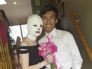 Gadis Ini Jadi Korban Luka Bakar, Ini yang Dilakukan Teman-temannya