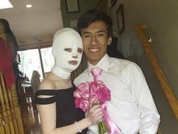 Gadis Ini Jadi Korban Luka Bakar, Ini yang Dilakukan Teman-temannya