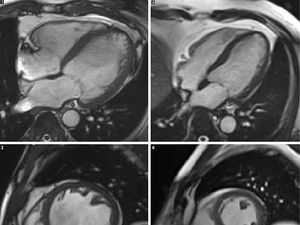Gambar Ini Tunjukkan Jantung Peminum Alkohol yang Bengkak