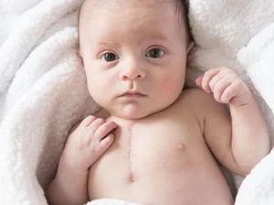 Alami Kondisi Jantung Langka, Bayi Ini Berhasil Bertahan Hidup