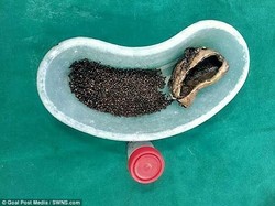 14 Gejala Batu Empedu, Penyebab dan Cara Mengobatinya