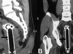 Mengaku Jatuh Saat Mandi, Kepala Shower Terjebak di Anus Sedalam 15 Cm