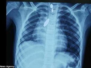 Magnet Masuk ke Paru-Paru, Dokter Gunakan Cara Ini untuk Mengeluarkannya Magnet Masuk ke Paru-Paru, Dokter Gunakan Cara Ini untuk Mengeluarkannya