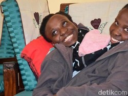 Kembar Siam Maria dan Consolata Meninggal di Usia 21 Tahun