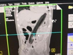 Ingin Atasi Sembelit, Pria Ini Masukkan Terong Sepanjang 30 Cm