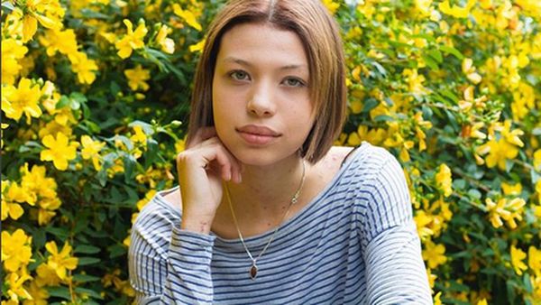 Model Idap Penyakit Kulit Langka Buktikan Cantik Tak Harus Mulus